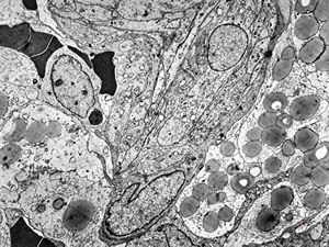 F,49y. | hemangioblastoma - brain F,49y. | hemangioblastoma - brain